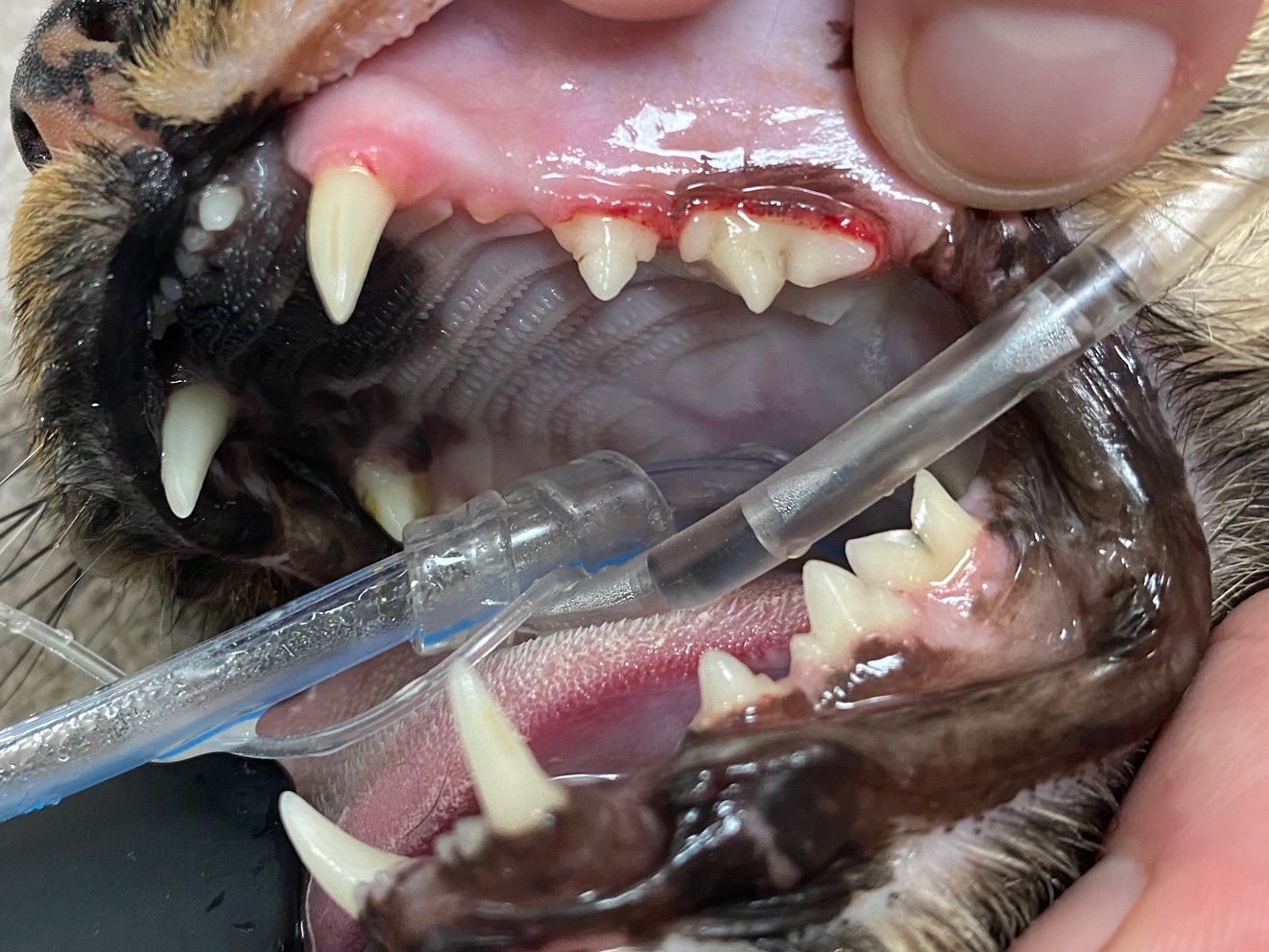 Teeth Extractions