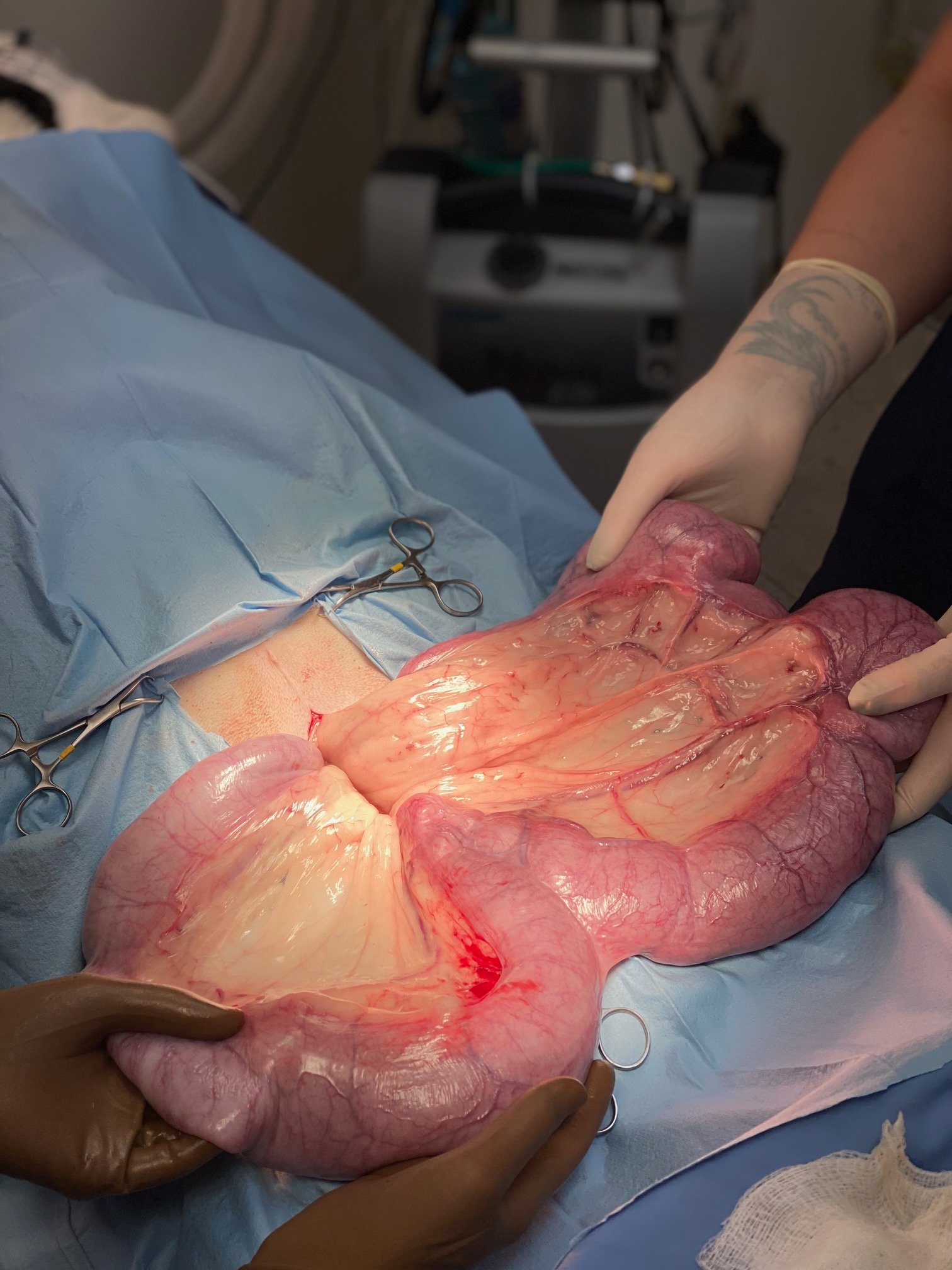 Uterine Infection