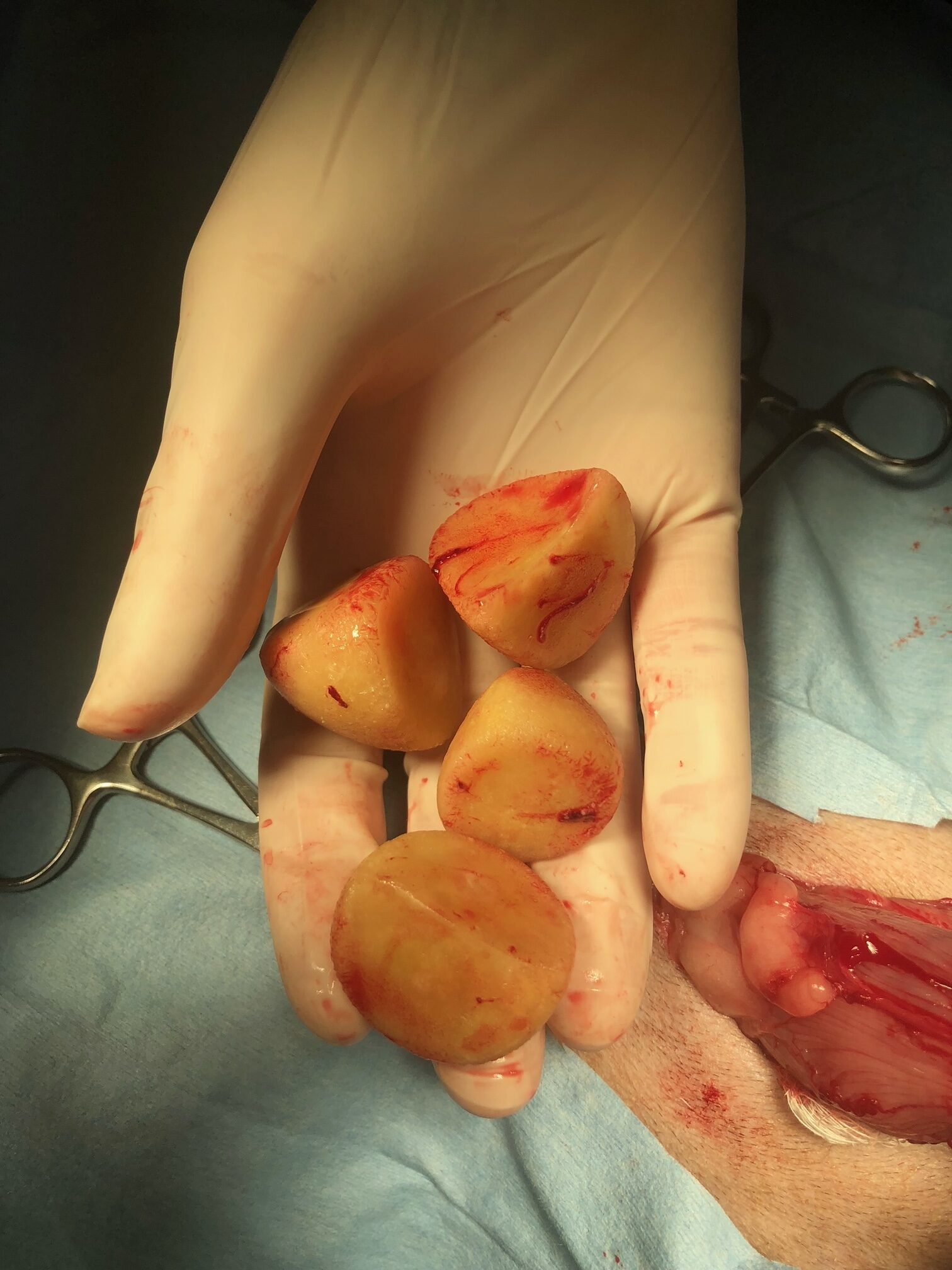Bladder Stones