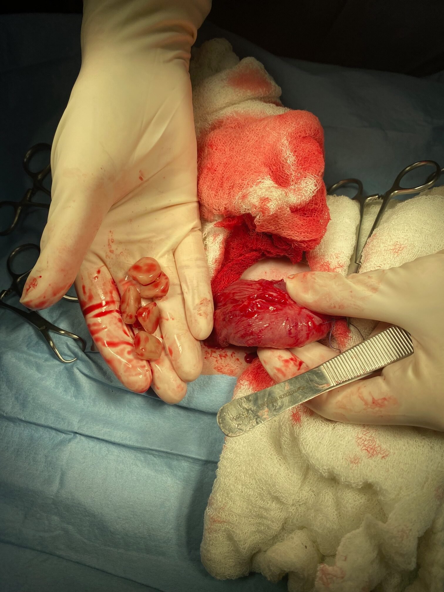 Cystotomy