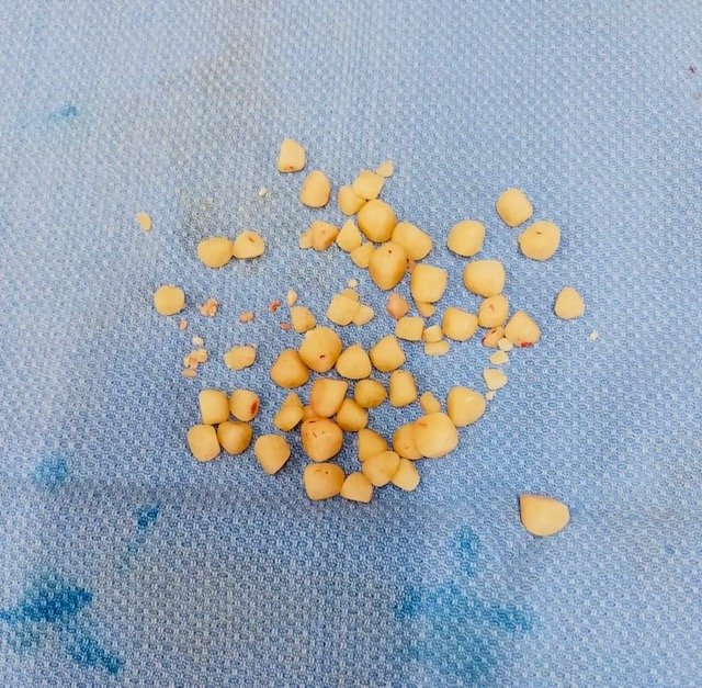 Bladder Stones